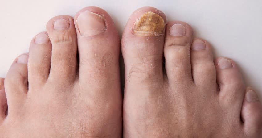 Micosi alle unghie: come riconoscerla e curarla?